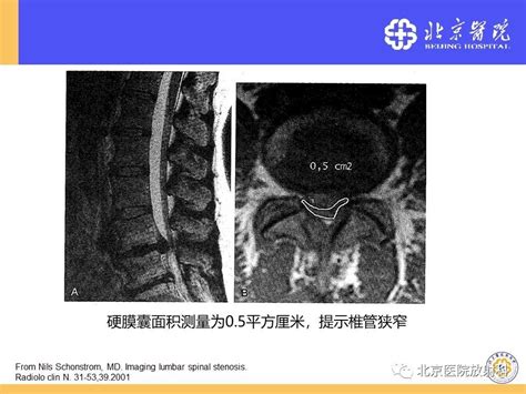 椎管狭窄偏方断根