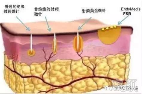 为什么有些妊娠纹是红色的