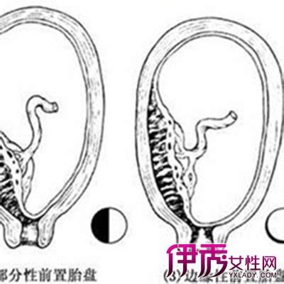 孕22周胎盘厚度22正常么