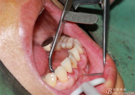 成人牙槽骨突出手术大概多少钱