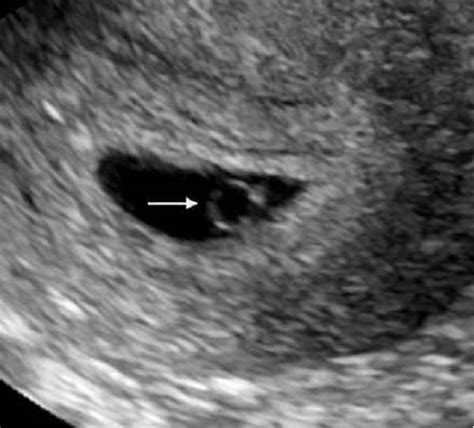 内见卵黄囊与胎芽未见明显胎心