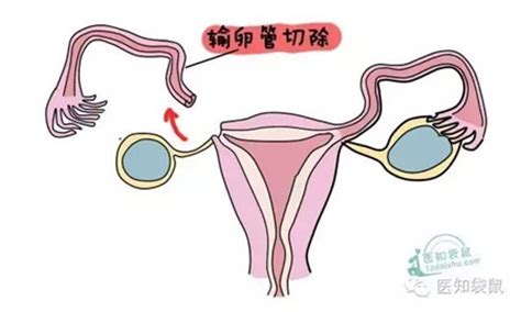 宫外孕身体会发出哪些信号