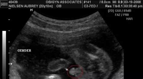 怀孕多久会出现胎心胎芽和孕囊