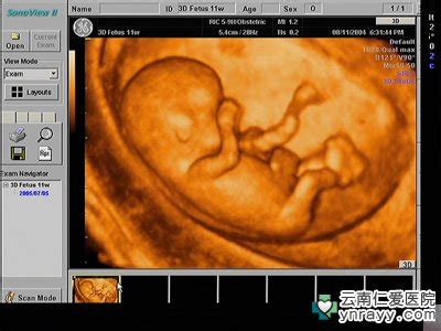 四个月b超胎儿偏小头大