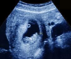 孕期12周胎盘厚度正常值