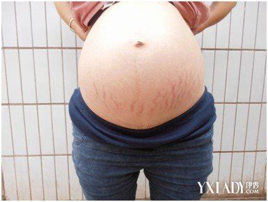 孕期怎么减少妊娠纹