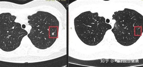 肺部结节是什么原因引起的