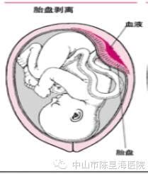 胎盘早剥多久胎儿缺氧
