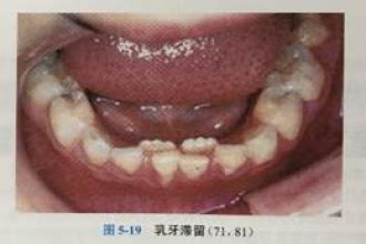 乳牙萌出期的口腔保健
