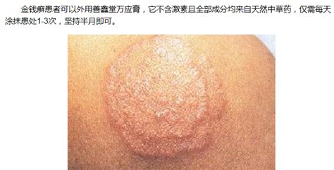 銅錢癬是什么癥狀?