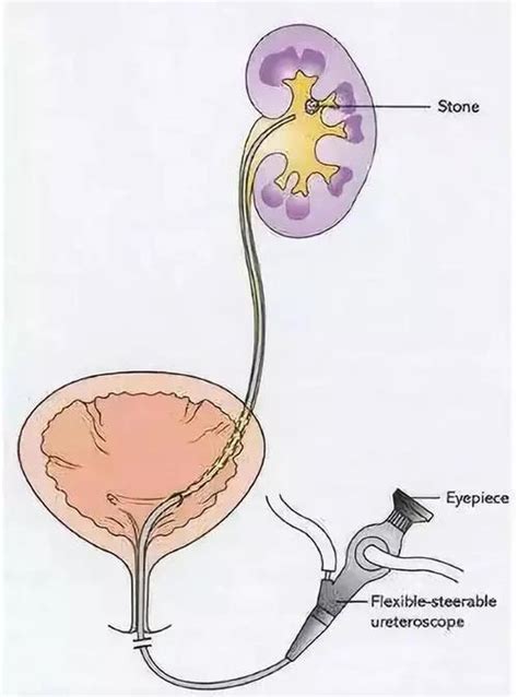 输尿管软镜取输尿管结石