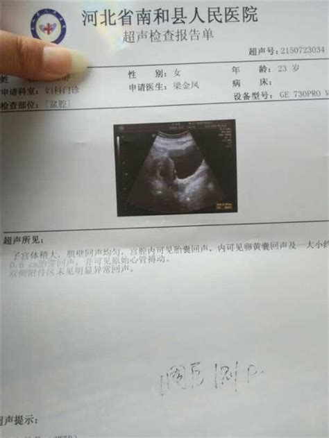 怀孕两个月的b超孕囊图