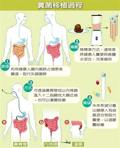 刘涛同款益生菌治便秘怎么样