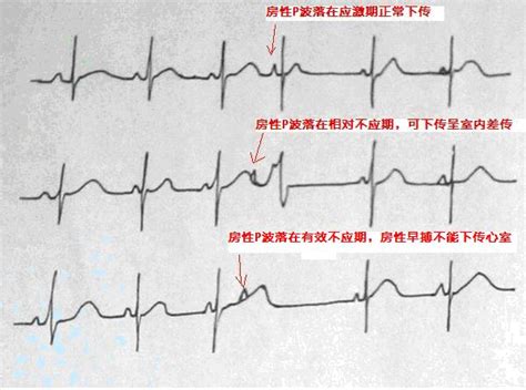 室性早搏6000算严重吗