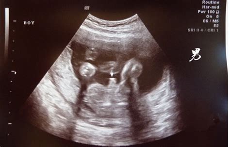 胎儿发育快是男孩还是女孩