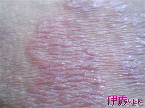 新生儿大腿根内侧褶皱处开裂