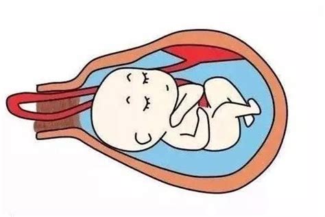 胎儿什么时候最容易脐带绕颈