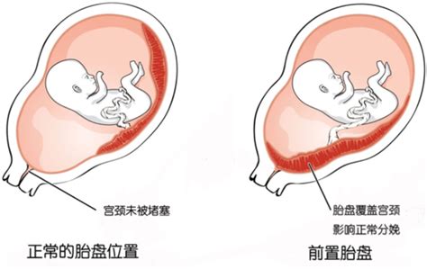 胎盘位于子宫前壁0级
