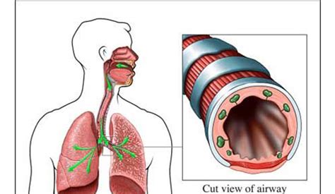 气管炎调养方法
