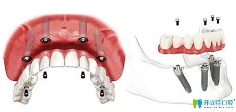 钢丝固定假牙制作过程