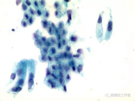 液基细胞学是不是就是tct