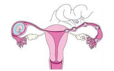 子宫内膜异位怎么引发的