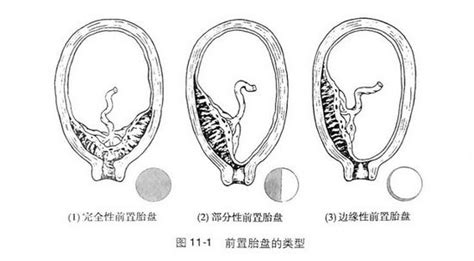 孕32周臀位还能转到头位吗