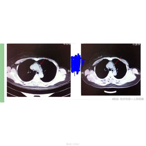 绝经2年乳房一蹦一跳痛