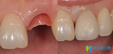 种植牙过程分为几个步骤多长时间