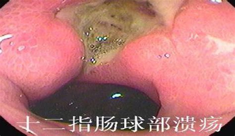 溃疡性结肠炎吃什么药