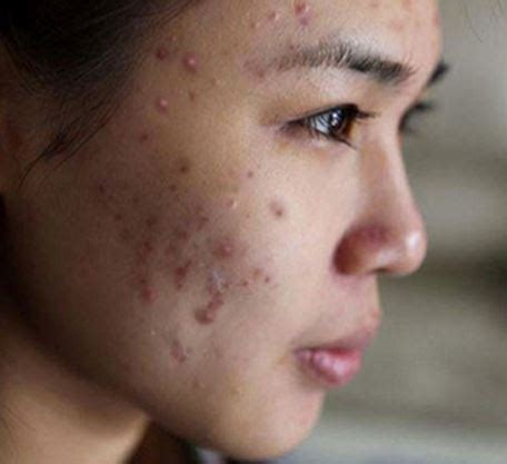 怀孕8周脸上痘痘少了