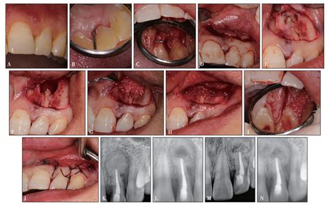 侧切是切哪里3d动画演示