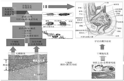 引起子宫内膜异位症的原因