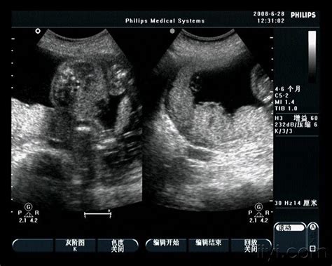胎儿2个月是什么样子