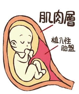 孕妇胎盘前置怎么办