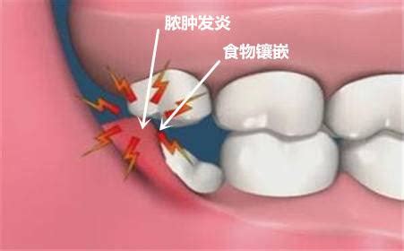 怀孕期牙龈出血怎么办