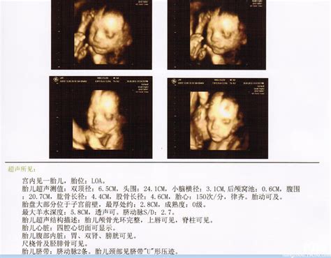 胎儿四维彩超图性别