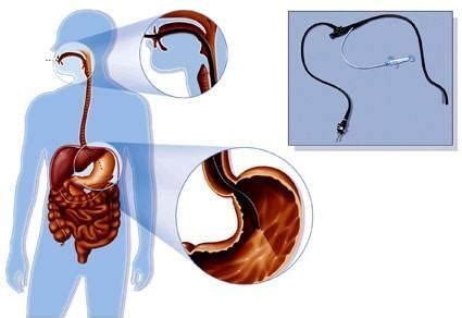 备孕期间做胃镜检查会有影响吗