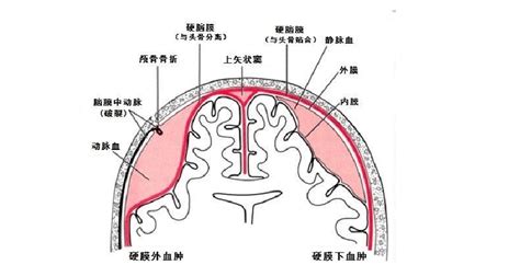 双侧额部硬膜下积液能自愈吗