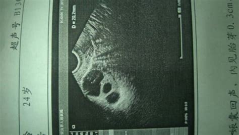 怀孕2个月的b超图
