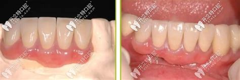 塑钢假牙和树脂假牙的区别