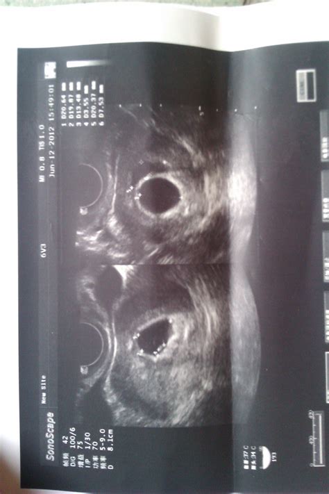 怀孕6周可以看到卵黄囊