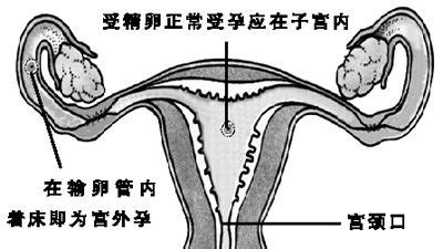 误入宫外孕怎么办