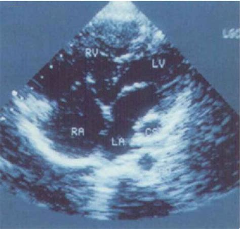胎儿心脏彩超有个钙化点