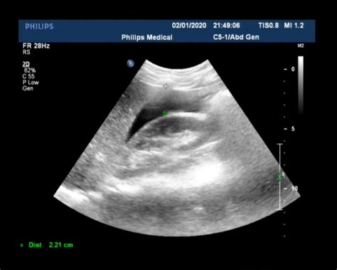 输卵管妊娠最常见的部位图片