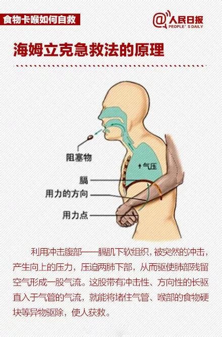 海姆立克法