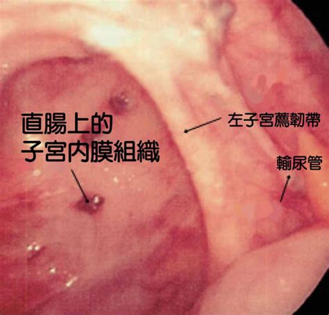 子宫后位的危害