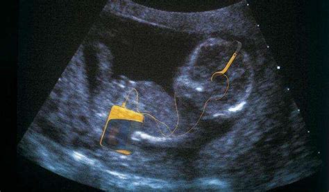 孕中期胎儿想要互动的表现