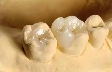 树脂假牙用什么材料做的