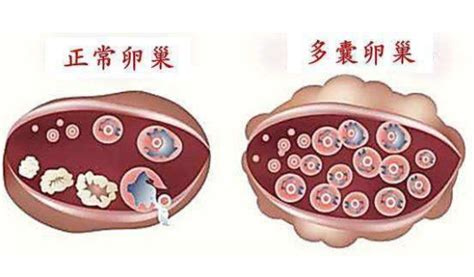 女性卵巢囊肿会影响怀孕吗